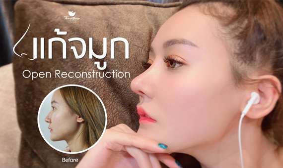 แก้จมูก Open-หมอกัน-ธีระธรฌ์คลินิก-จมูก-รีวิว