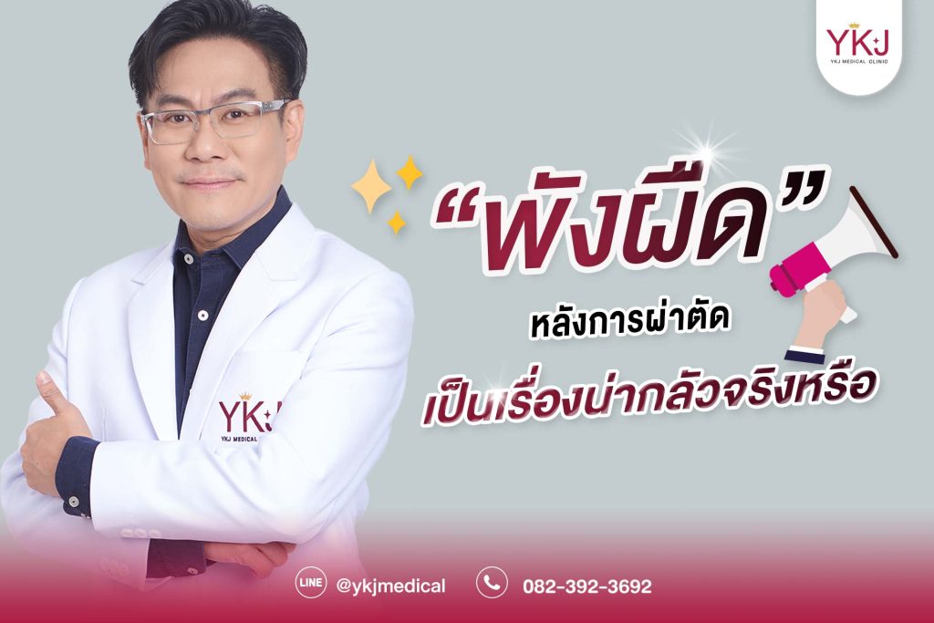 ปกสวยพังผืด