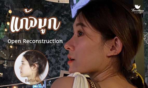 แก้จมูก Open-หมอกัน-ธีระธรฌ์คลินิก-จมูก-รีวิว