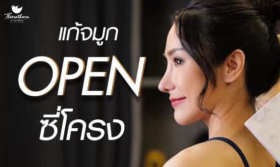 จมูกโอเพ่นซี่โครง-เสริมจมูก-จมูกโอเพ่น-ธีระธรฌ์คลินิก-หมอกัน