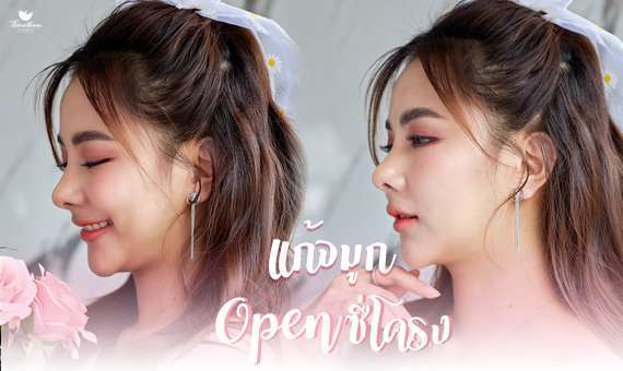 จมูกโอเพ่นซี่โครง-เสริมจมูก-จมูกโอเพ่น-ธีระธรฌ์คลินิก-หมอกัน