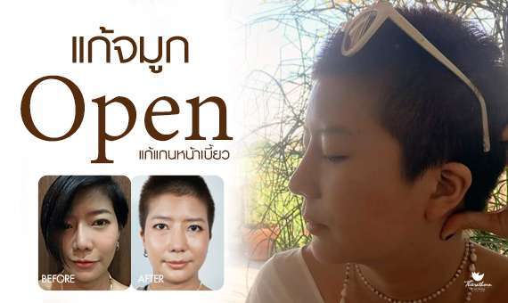 แก้จมูก Open-หมอกัน-ธีระธรฌ์คลินิก-จมูก-รีวิว