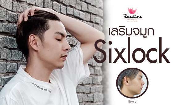 เสริมจมูก-เสริมจมูกผู้ชาย-จมูกsixlock-หมอกัน-ธีระธรฌ์คลินิก