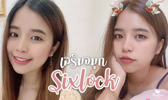 เสริมจมูก-เสริมจมูกครั้งแรก-จมูกsixlock-หมอกัน-ธีระธรฌ์คลินิก