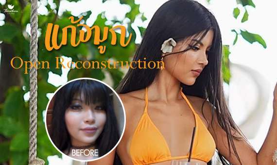 แก้จมูก Open-หมอกัน-ธีระธรฌ์คลินิก-จมูก-รีวิว