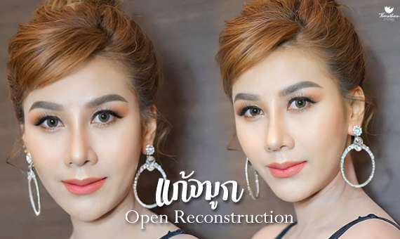 แก้จมูก Open-หมอกัน-ธีระธรฌ์คลินิก-จมูก-รีวิว