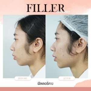 ฟิลเลอร์-Filler-ฟิลเลอร์คืออะไร-Fillerคืออะไร-ฟิลเลอร์คาง-คางแบบไหนที่ควรฉีดฟิลเลอร์-ฟิลเลอร์คางใช้กี่ซีซี—ฉีดฟิลเลอร์คาง-การปฏิบัติตัวก่อนการฉีดฟิลเลอร์-การดูแลตัวเองหลังจากฉีดฟิลเลอร์-ฉีดฟิลเลอร์คางปรับโหงวเฮ้ง-ทำไมต้องฉีดฟิลเลอร์กับหมอกัน-เลือกใช้ฟิลเลอร์ยี่ห้อไหน ในการฉีดฟิลเลอร์คาง-รีวิวฟิลเลอร์คาง-ทำไมต้องฉีดฟิลเลอร์กับหมอกัน-หมอกัน-ธีระธรฌ์คลินิก