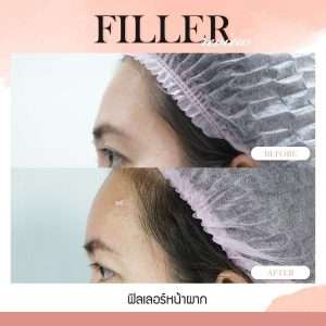 ฟิลเลอร์-ใช้เข็มทู่ฉีดฟิลเลอร์-ใช้เข็มแหลมฉีดฟิลเลอร์-ทำไมต้องฉีดฟิลเลอร์กับหมอกัน-หมอกัน-ธีระธรฌ์คลินิก