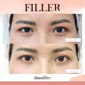 ฟิลเลอร์-Filler-ฟิลเลอร์คืออะไร-Fillerคืออะไร-ฟิลเลอร์ใต้ตา-ใต้ตาแบบไหนที่ควรฉีดฟิลเลอร์-ฟิลเลอร์ใต้ตาใช้กี่ซีซี—ฉีดฟิลเลอร์ใต้ตา-การปฏิบัติตัวก่อนการฉีดฟิลเลอร์-การดูแลตัวเองหลังจากฉีดฟิลเลอร์-ฉีดฟิลเลอร์ใต้ตาปรับโหงวเฮ้ง-ทำไมต้องฉีดฟิลเลอร์กับหมอกัน-เลือกใช้ฟิลเลอร์ยี่ห้อไหน ในการฉีดฟิลเลอร์ใต้ตา-รีวิวฟิลเลอร์ใต้ตา-ทำไมต้องฉีดฟิลเลอร์กับหมอกัน-หมอกัน-ธีระธรฌ์คลินิก
