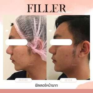 ฉีดฟิลเลอร์ต้องรู้อะไรบ้าง-ฟิลเลอร์ คือ-ฟิลเลอร์เติมจุดไหนได้บ้าง-ตำแหน่งในการฉีดฟิลเลอร์-ฟิลเลอร์สลายหมดหรือไม่สลาย-ฉีดฟิลเลอร์อันตรายไหม-ฟิลเลอร์แต่ละยี่ห้อแตกต่างกันอย่างไร-ฟิลเลอร์ Juvederm -ฟิลเลอร์ Restylane-ฟิลเลอร์ Perfectha-ฟิลเลอร์ Neuramis-วิธีตรวจสอบฟิลเลอร์-การปฏิบัติตัวก่อนการฉีดฟิลเลอร์-การดูแลตัวเองหลังจากฉีดฟิลเลอร์-หมอกัน-ธีระธรฌ์คลินิก