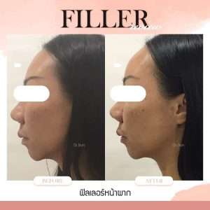 ฟิลเลอร์-Filler-ฟิลเลอร์คืออะไร-ฟิลเลอร์สลายได้จริงหรอ -ฉีดสลายฟิลเลอร์-วิธีตรวจสอบฟิลเลอร์-หมอกัน-ธีระธรฌ์คลินิก
