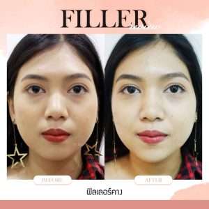 ฟิลเลอร์-Filler-ฟิลเลอร์คืออะไร-Fillerคืออะไร-ฟิลเลอร์คาง-คางแบบไหนที่ควรฉีดฟิลเลอร์-ฟิลเลอร์คางใช้กี่ซีซี—ฉีดฟิลเลอร์คาง-การปฏิบัติตัวก่อนการฉีดฟิลเลอร์-การดูแลตัวเองหลังจากฉีดฟิลเลอร์-ฉีดฟิลเลอร์คางปรับโหงวเฮ้ง-ทำไมต้องฉีดฟิลเลอร์กับหมอกัน-เลือกใช้ฟิลเลอร์ยี่ห้อไหน ในการฉีดฟิลเลอร์คาง-รีวิวฟิลเลอร์คาง-ทำไมต้องฉีดฟิลเลอร์กับหมอกัน-หมอกัน-ธีระธรฌ์คลินิก