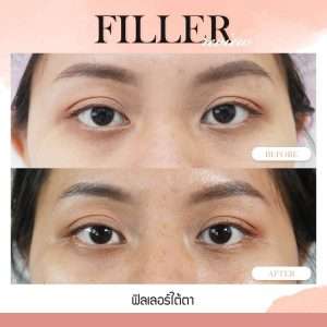 ฟิลเลอร์-Filler-ฟิลเลอร์คืออะไร-Fillerคืออะไร-ฟิลเลอร์ใต้ตา-ใต้ตาแบบไหนที่ควรฉีดฟิลเลอร์-ฟิลเลอร์ใต้ตาใช้กี่ซีซี—ฉีดฟิลเลอร์ใต้ตา-การปฏิบัติตัวก่อนการฉีดฟิลเลอร์-การดูแลตัวเองหลังจากฉีดฟิลเลอร์-ฉีดฟิลเลอร์ใต้ตาปรับโหงวเฮ้ง-ทำไมต้องฉีดฟิลเลอร์กับหมอกัน-เลือกใช้ฟิลเลอร์ยี่ห้อไหน ในการฉีดฟิลเลอร์ใต้ตา-รีวิวฟิลเลอร์ใต้ตา-ทำไมต้องฉีดฟิลเลอร์กับหมอกัน-หมอกัน-ธีระธรฌ์คลินิก
