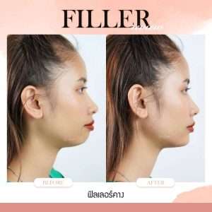 ฟิลเลอร์-Filler-ฟิลเลอร์คืออะไร-Fillerคืออะไร-ฟิลเลอร์คาง-คางแบบไหนที่ควรฉีดฟิลเลอร์-ฟิลเลอร์คางใช้กี่ซีซี—ฉีดฟิลเลอร์คาง-การปฏิบัติตัวก่อนการฉีดฟิลเลอร์-การดูแลตัวเองหลังจากฉีดฟิลเลอร์-ฉีดฟิลเลอร์คางปรับโหงวเฮ้ง-ทำไมต้องฉีดฟิลเลอร์กับหมอกัน-เลือกใช้ฟิลเลอร์ยี่ห้อไหน ในการฉีดฟิลเลอร์คาง-รีวิวฟิลเลอร์คาง-ทำไมต้องฉีดฟิลเลอร์กับหมอกัน-หมอกัน-ธีระธรฌ์คลินิก