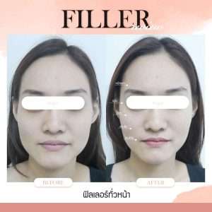 ฟิลเลอร์-ใช้เข็มทู่ฉีดฟิลเลอร์-ใช้เข็มแหลมฉีดฟิลเลอร์-ทำไมต้องฉีดฟิลเลอร์กับหมอกัน-หมอกัน-ธีระธรฌ์คลินิก
