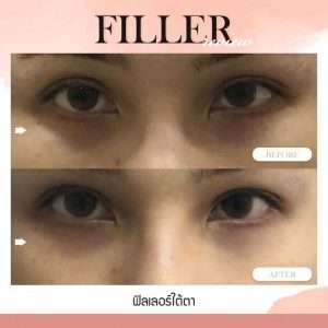 ฟิลเลอร์-Filler-ฟิลเลอร์คืออะไร-Fillerคืออะไร-ฟิลเลอร์ใต้ตา-ใต้ตาแบบไหนที่ควรฉีดฟิลเลอร์-ฟิลเลอร์ใต้ตาใช้กี่ซีซี—ฉีดฟิลเลอร์ใต้ตา-การปฏิบัติตัวก่อนการฉีดฟิลเลอร์-การดูแลตัวเองหลังจากฉีดฟิลเลอร์-ฉีดฟิลเลอร์ใต้ตาปรับโหงวเฮ้ง-ทำไมต้องฉีดฟิลเลอร์กับหมอกัน-เลือกใช้ฟิลเลอร์ยี่ห้อไหน ในการฉีดฟิลเลอร์ใต้ตา-รีวิวฟิลเลอร์ใต้ตา-ทำไมต้องฉีดฟิลเลอร์กับหมอกัน-หมอกัน-ธีระธรฌ์คลินิก