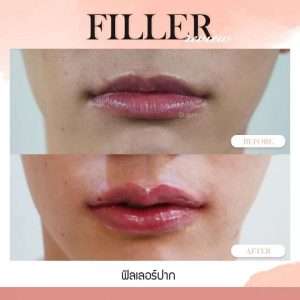 ฟิลเลอร์-Filler-ฟิลเลอร์คืออะไร-Fillerคืออะไร-ฟิลเลอร์ใช้กี่ซีซี-จุดไหนฉีดฟิลเลอร์ได้บ้าง-การปฏิบัติตัวก่อนการฉีดฟิลเลอร์-การดูแลตัวเองหลังจากฉีดฟิลเลอร์-ฉีดฟิลเลอร์ปรับโหงวเฮ้ง-ฉีดฟิลเลอร์เติมเต็ม-ฉีดฟิลเลอร์ปรับรูปหน้า-ทำไมต้องฉีดฟิลเลอร์กับหมอกัน-เลือกใช้ฟิลเลอร์ยี่ห้อไหนดี-ฟิลเลอร์ยี่ห้อไหนดี-รีวิวฟิลเลอร์-ทำไมต้องฉีดฟิลเลอร์กับหมอกัน-หมอกัน-ธีระธรฌ์คลินิก