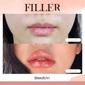 ฟิลเลอร์-Filler-ฟิลเลอร์คืออะไร-Fillerคืออะไร-ฟิลเลอร์ใช้กี่ซีซี-จุดไหนฉีดฟิลเลอร์ได้บ้าง-การปฏิบัติตัวก่อนการฉีดฟิลเลอร์-การดูแลตัวเองหลังจากฉีดฟิลเลอร์-ฉีดฟิลเลอร์ปรับโหงวเฮ้ง-ฉีดฟิลเลอร์เติมเต็ม-ฉีดฟิลเลอร์ปรับรูปหน้า-ทำไมต้องฉีดฟิลเลอร์กับหมอกัน-เลือกใช้ฟิลเลอร์ยี่ห้อไหนดี-ฟิลเลอร์ยี่ห้อไหนดี-รีวิวฟิลเลอร์-ทำไมต้องฉีดฟิลเลอร์กับหมอกัน-หมอกัน-ธีระธรฌ์คลินิก