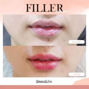 ฟิลเลอร์-Filler-ฟิลเลอร์คืออะไร-Fillerคืออะไร-ฟิลเลอร์ใช้กี่ซีซี-จุดไหนฉีดฟิลเลอร์ได้บ้าง-การปฏิบัติตัวก่อนการฉีดฟิลเลอร์-การดูแลตัวเองหลังจากฉีดฟิลเลอร์-ฉีดฟิลเลอร์ปรับโหงวเฮ้ง-ฉีดฟิลเลอร์เติมเต็ม-ฉีดฟิลเลอร์ปรับรูปหน้า-ทำไมต้องฉีดฟิลเลอร์กับหมอกัน-เลือกใช้ฟิลเลอร์ยี่ห้อไหนดี-ฟิลเลอร์ยี่ห้อไหนดี-รีวิวฟิลเลอร์-ทำไมต้องฉีดฟิลเลอร์กับหมอกัน-หมอกัน-ธีระธรฌ์คลินิก