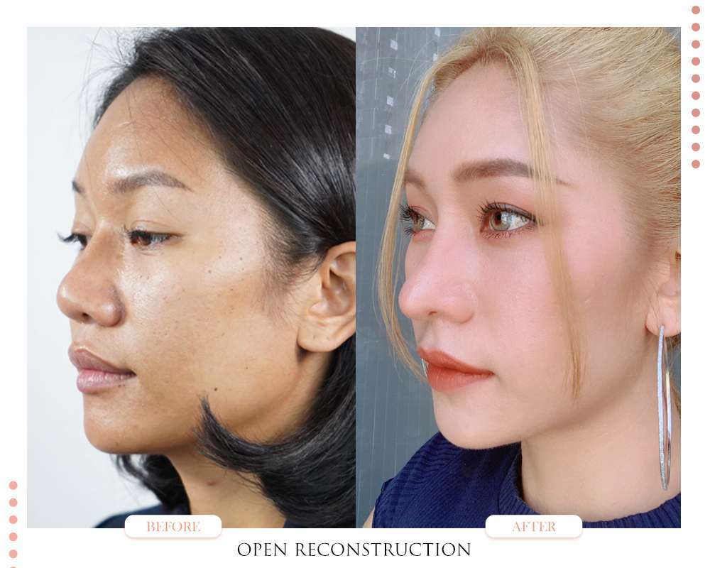 แก้จมูก Open-แก้จมูกโอเพ่น-หมอกัน-ธีระธรฌ์คลินิก-จมูก-รีวิว