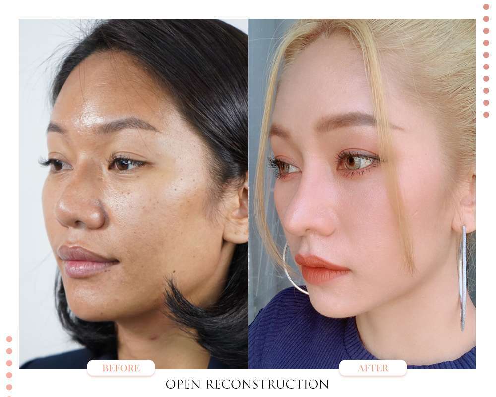 แก้จมูก Open-แก้จมูกโอเพ่น-หมอกัน-ธีระธรฌ์คลินิก-จมูก-รีวิว