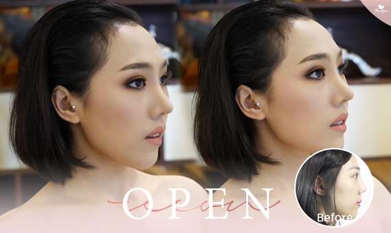 แก้จมูก Open-แก้จมูกโอเพ่น-หมอกัน-ธีระธรฌ์คลินิก-จมูก-รีวิว
