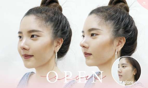 แก้จมูก Open-แก้จมูกโอเพ่น-หมอกัน-ธีระธรฌ์คลินิก-จมูก-รีวิว