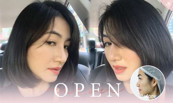 แก้จมูก Open-แก้จมูกโอเพ่น-หมอกัน-ธีระธรฌ์คลินิก-จมูก-รีวิว