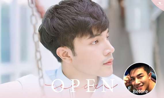 แก้จมูก Open-แก้จมูกโอเพ่น-หมอกัน-ธีระธรฌ์คลินิก-จมูก-รีวิว