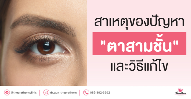 "ตาสามชั้น" คืออะไร ? ทำไมถึงเกิดปัญหาตาสามชั้น และวิธีแก้ไข
