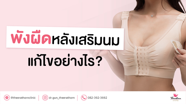 พังผืดหลังเสริมนม แก้ไขอย่างไร และสามารถป้องกันได้อย่างไร