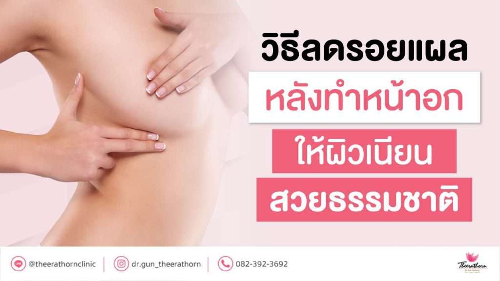 วิธีลดรอยแผลหลังทำหน้าอก ให้ผิวเนียนสวยธรรมชาติ