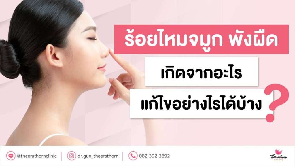 ร้อยไหมจมูก พังผืด เกิดจากอะไร แก้ไขอย่างไรได้บ้าง?