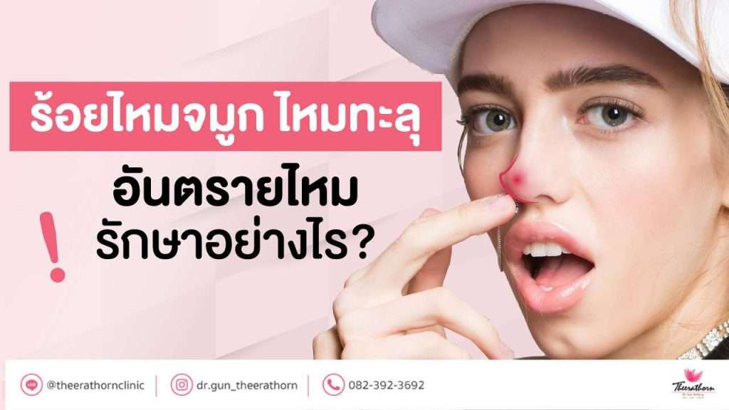 ร้อยไหมจมูก ไหมทะลุ อันตรายไหม รักษาอย่างไร?