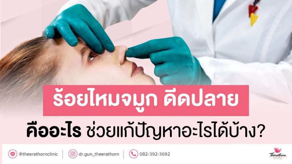 ร้อยไหมจมูก ดีดปลาย คืออะไร ช่วยแก้ปัญหาอะไรได้บ้าง?