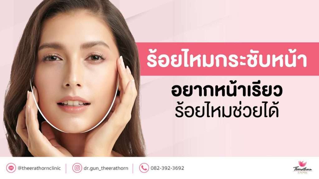 ร้อยไหมกระชับหน้า อยากหน้าเรียว ร้อยไหมช่วยได้