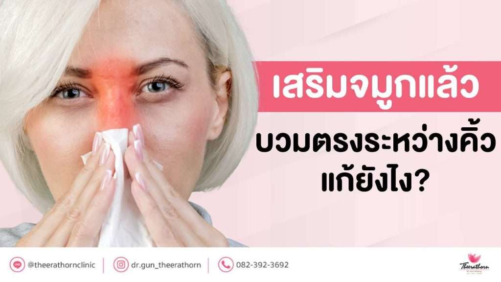 เสริมจมูกแล้ว บวมตรงระหว่างคิ้ว แก้ยังไง?