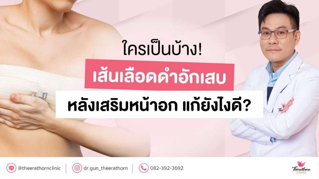 ใครเป็นบ้าง! เส้นเลือดดำอักเสบ หลังเสริมหน้าอก แก้ยังไงดี?