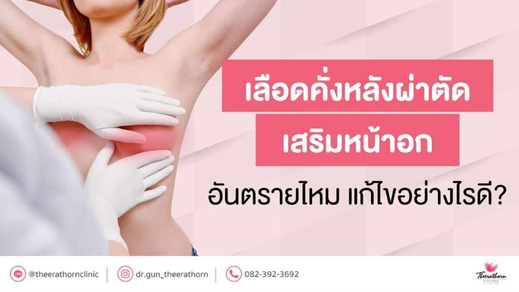 เลือดคั่งหลังผ่าตัด เสริมหน้าอก อันตรายไหม แก้ไขอย่างไรดี?