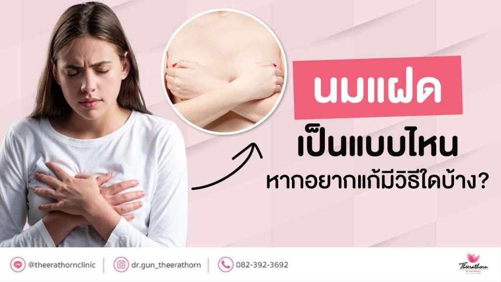 นมแฝด-เป็นแบบไหน หากอยากแก้มีวิธีใดบ้าง?