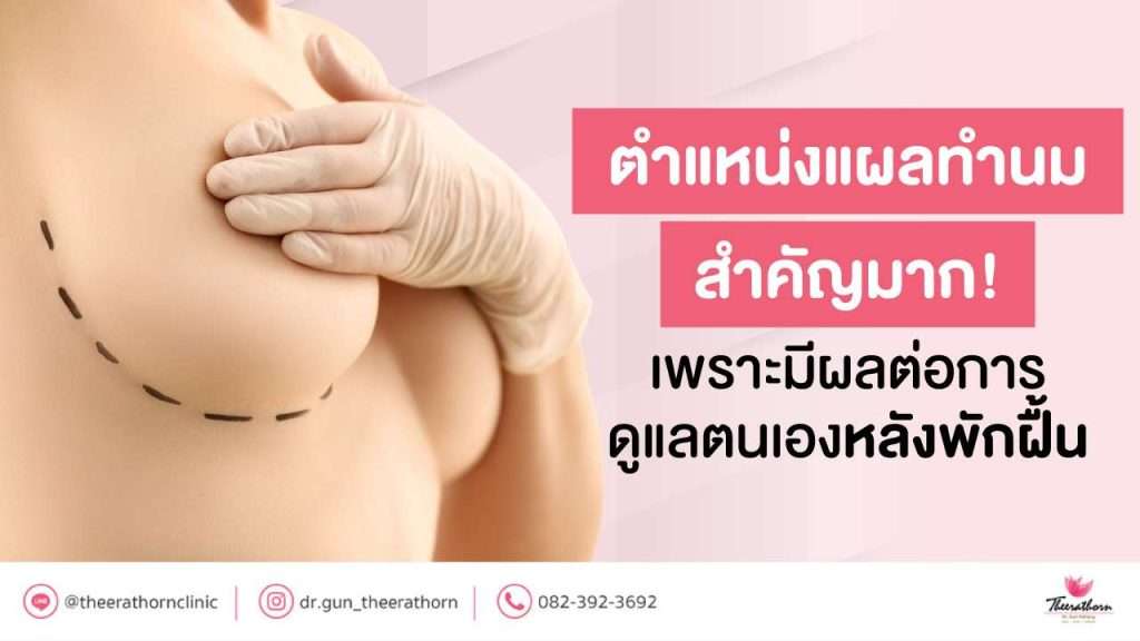 ตำแหน่งแผลทำนม สำคัญมาก! เพราะมีผลต่อการดูแลตนเองหลังพักฝื้น