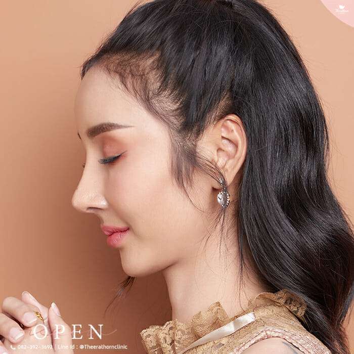 แก้จมูก, เคยแก้จมูกหลายครั้ง