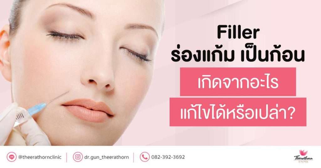 Filler ร่องแก้ม เป็นก้อน เกิดจากอะไร แก้ไขได้หรือเปล่า?