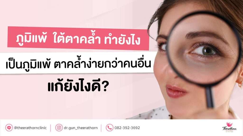ภูมิแพ้ ใต้ตาคล้ำ ทำยังไง เป็นภูมิแพ้ ตาคล้ำง่ายกว่าคนอื่น แก้ยังไงดี?