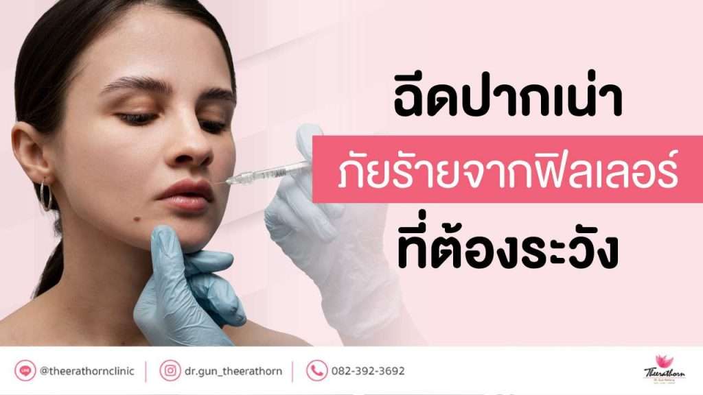 ฉีดปากเน่า ภัยรัายจากฟิลเลอร์ ที่ต้องระวัง