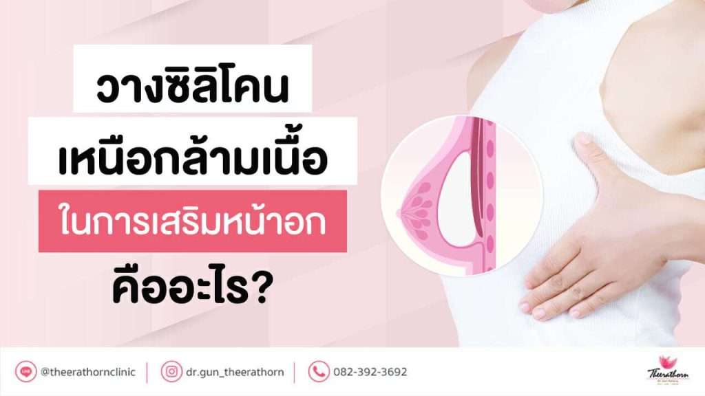 วางซิลิโคนเหนือกล้ามเนื้อ ในการเสริมหน้าอก คืออะไร?