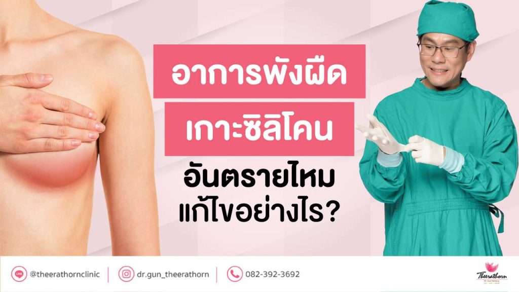 อาการพังผืดเกาะ ซิลิโคน อันตรายไหม แก้ไขอย่างไร?