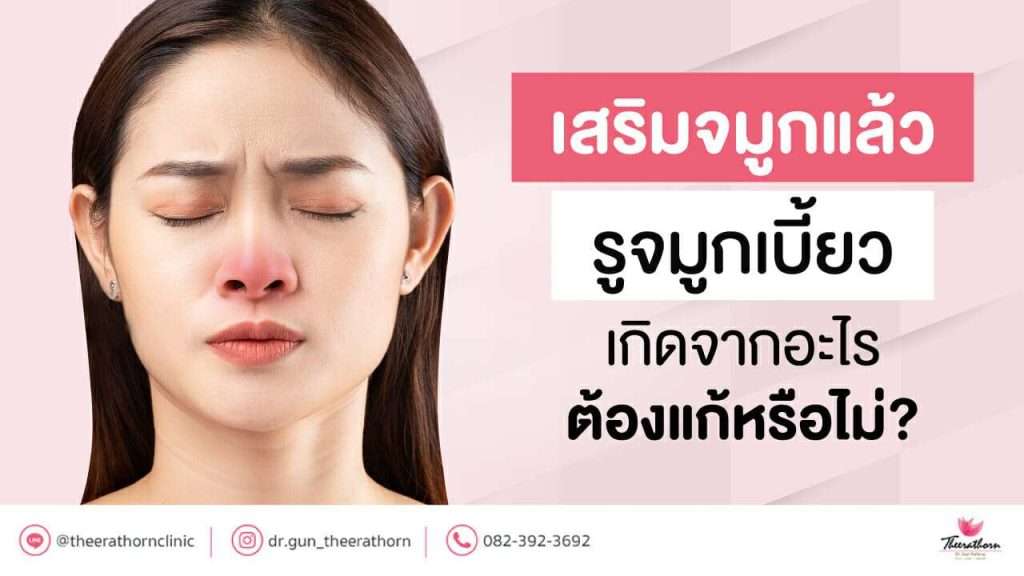 เสริมจมูกแล้ว รูจมูกเบี้ยว เกิดจากอะไร ต้องแก้หรือไม่?