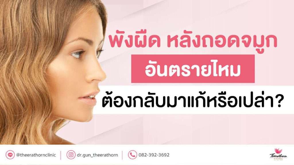 พังผืด หลังถอด จมูก อันตรายไหม ต้องกลับมาแก้หรือเปล่า?