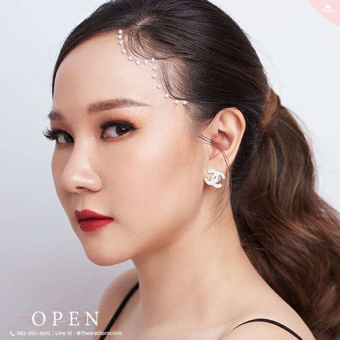 แก้จมูก, ปลายจมูกงุ้ม